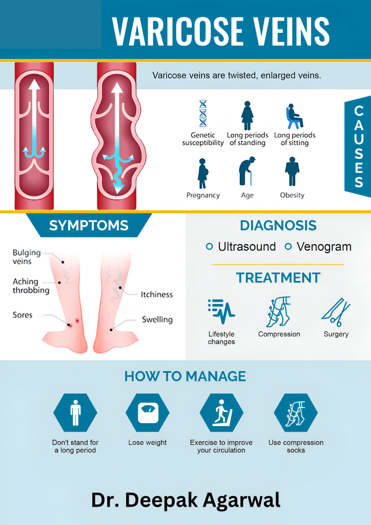 All About Varicose Veins