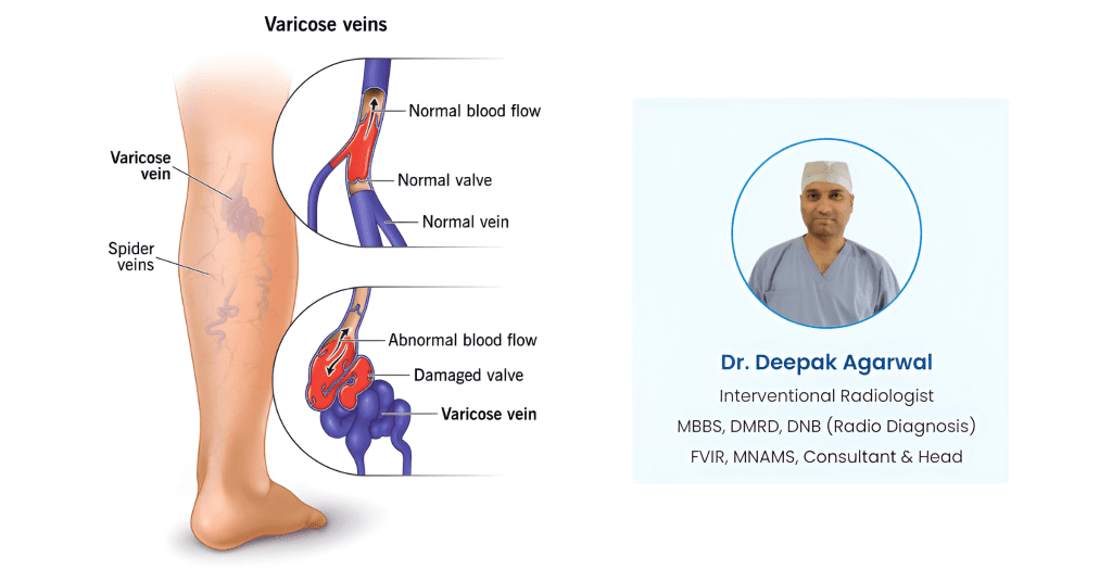 Varicose Veins