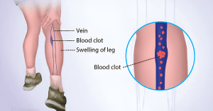 DVT Treatment in Jaipur