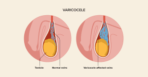 Varicocele Treatment in Jaipur